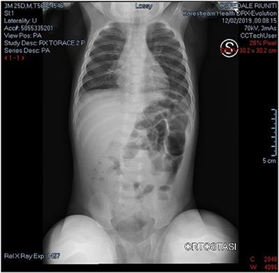 A Rare Case of Mesenteric Chylous Cyst in Infant: Case Report and Review of Literature